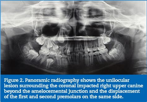 [pdf] Surgical Treatment Of Adenomatoid Odontogenic Tumor A 5 Year