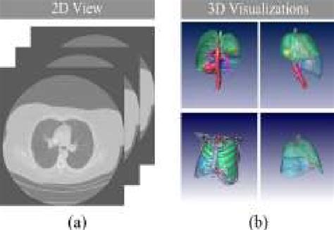 Figure From Automatic Segmentation Of Lung Lobes And Fissures For