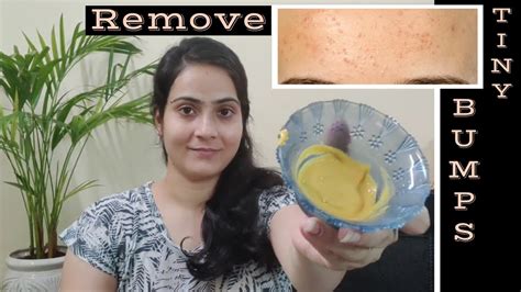 Remove Tiny Bumps On Face At Home Diy Home Remedy In Hindi Easy