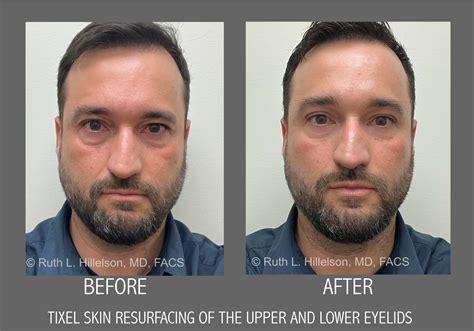 Tixel ® Skin Resurfacing