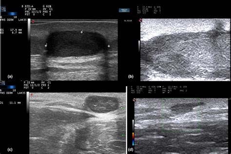 Subcutaneous Dermoid Cyst Ultrasound