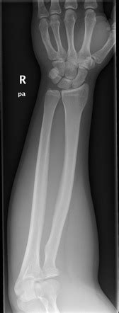 Radial Neck Fracture Radiology Case Radiopaedia Org