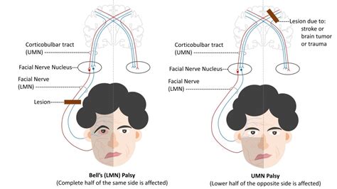 Facialis Parese