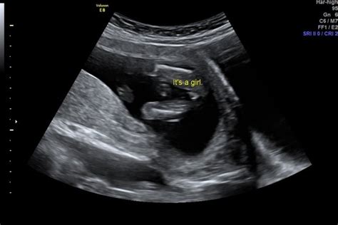 Its A Girl Ultrasound 16 Weeks