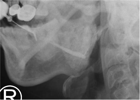 Differences Between Radioactive Iodine Induced Sialadenitis And Chronic