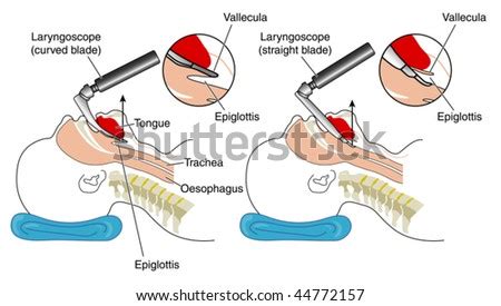 Laryngoscope Stock Photos, Images, & Pictures | Shutterstock