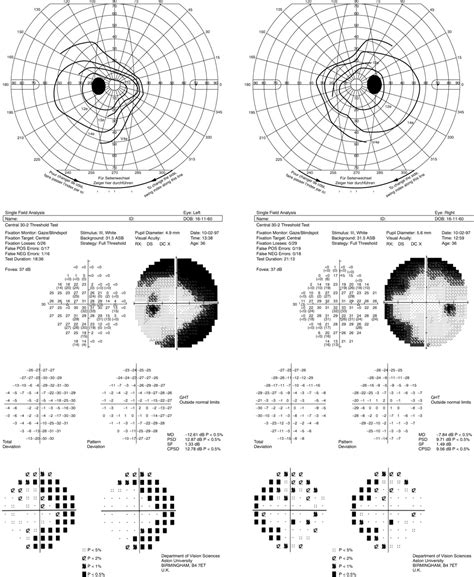 Visual Field Defects Associated With Vigabatrin Therapy Journal Of