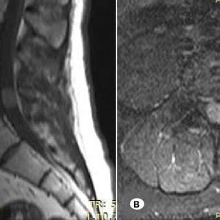 Sagittal A And Axial B Mri Scans Of A Years Old Male Patient