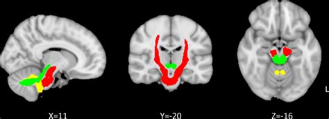 Tracts Of Interest The Bilateral Cortico Ponto Cerebellar Tracts The