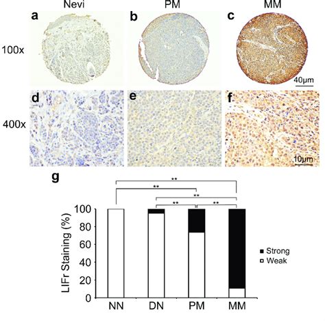 LIFr Expression Is Increased In Human Advanced Melanoma Representative