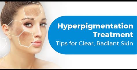 Hyperpigmentation Treatment Options