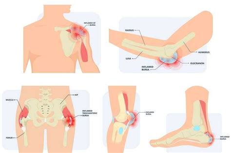 Slijmbeursontsteking Fysiotherapie Cuijk Heeswijkse Kampen