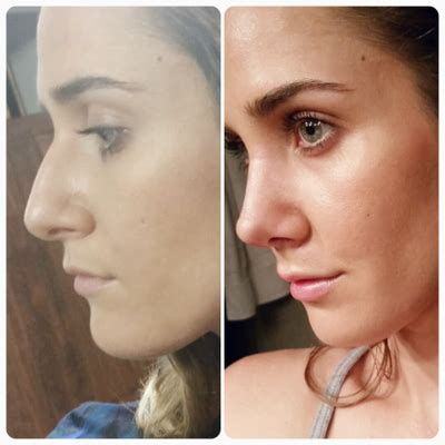 Nose Job Recovery Time Arie Sowers