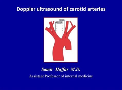 Doppler ultrasound of carotid arteries