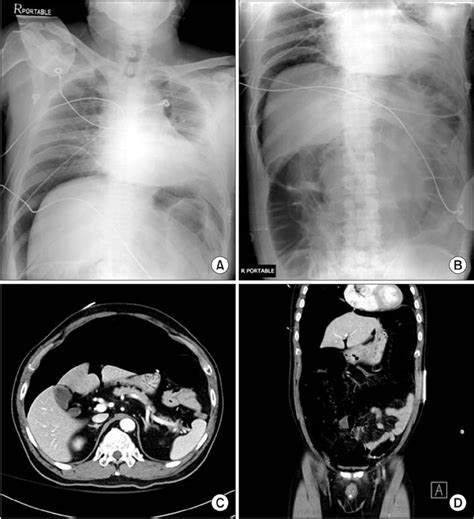 Single Port Laparoscopic Repair Of Sigmoid Colon Perforation During Colonoscopy