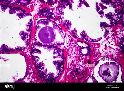 Benign Prostatic Hyperplasia Light Micrograph Photo Under Microscope