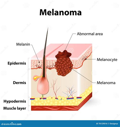 Melanoma Cartoons, Illustrations & Vector Stock Images - 3581 Pictures ...