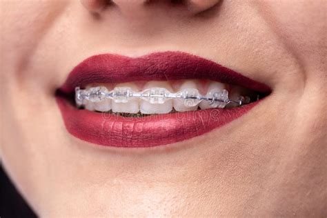 Beautiful Smile, Teeth and Braces Stock Image - Image of dental, nose ...