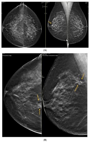 Current Oncology Free Full Text The Impact Of Dense Breasts On The