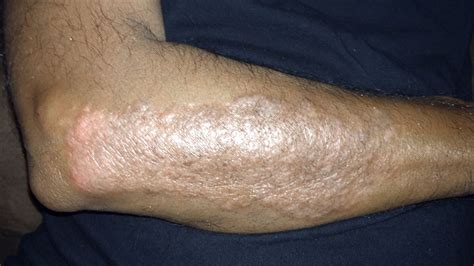 Psoriasis Elbow