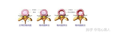 如何治疗腰椎间盘突出治腰椎间盘突出的药 知乎