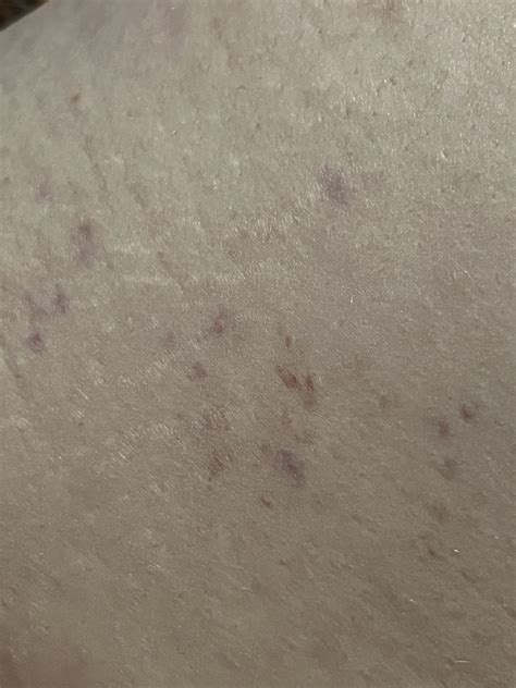 Odd Little Purple Splotches On My Thigh Rmedicaladvice