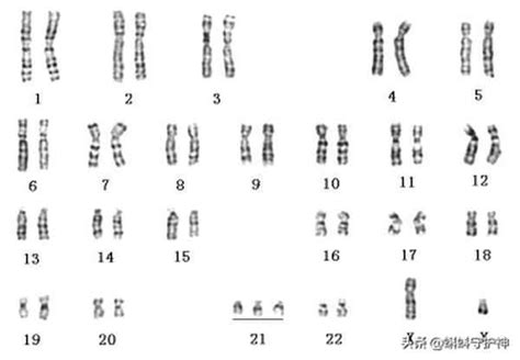 21 三体综合征的症状 21三体综合征的症状是什么 医疗机构 华网