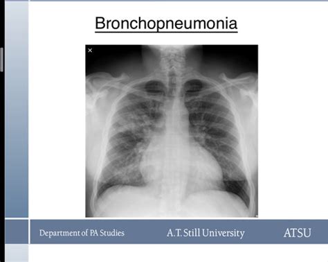 Pneumonia Flashcards Quizlet