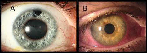 Material Analysis Of Spontaneously Subluxated Iris Fixated Phakic