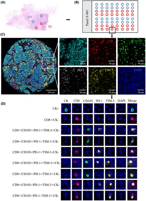 Dysfunction Of Cd8 T Cells Around Tumor Cells Leads To Occult Lymph Node Metastasis In Nsclc