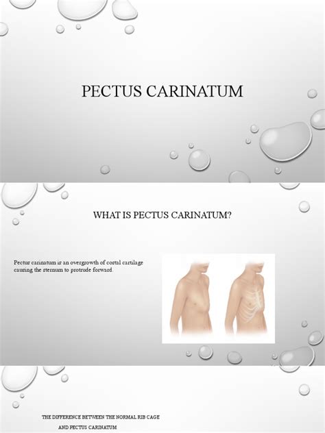 Pectus carinatum | PDF