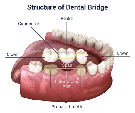 Dental Implants Vs Bridges Finding Whats Best For You