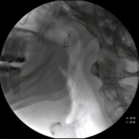 Parotid Sialogram Stone 2 Iowa Head And Neck Protocols