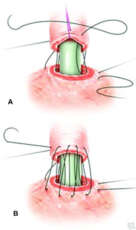 VUA Technique With RS A Continuing The Suture After Placing A