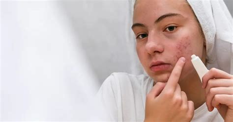 Espironolactona Serve Para Acne Antes E Depois Protocolo Da Pele