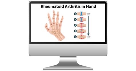 Turmeric For Rheumatoid Arthritis Know The Current Facts