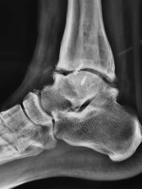 Anterior And Posterior Ankle Impingement Syndromes Foot And Ankle Clinics