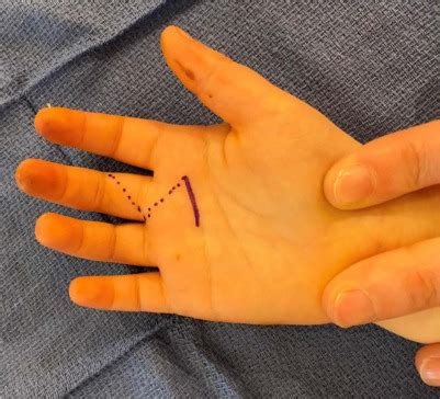 Masters Surgical Technique Surgical Treatment Of Trigger Thumb And