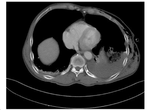 Chest Computed Tomography Scan Taken At Admission Revealed Multiple