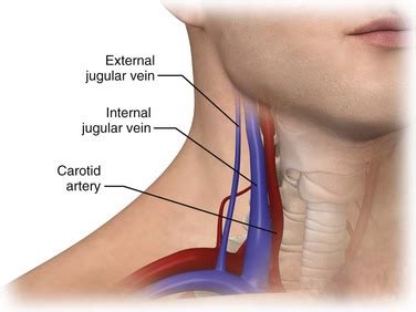 Procguide Internal Jugular Central Line 8B5