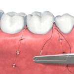 Periodontal Therapy GTA North Periodontics Endodontics