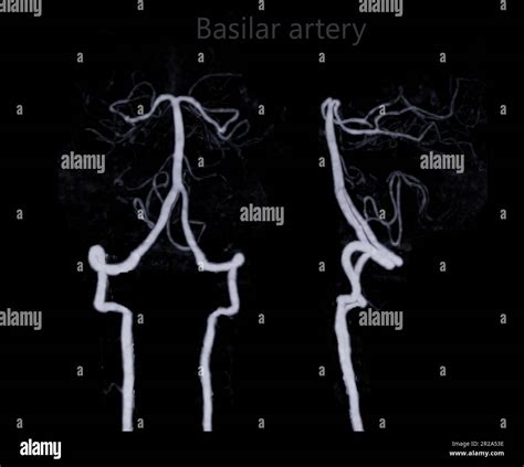 CT Angiography Of The Brain Or CTA Brain Showing Basilar Artery Stock