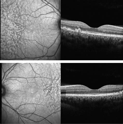 Early Onset Drusen Part I — Retina Specialists