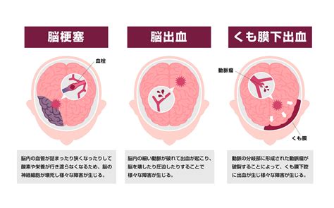 「脳出血」とは？症状・原因・治療法についても解説！ メディカルドック