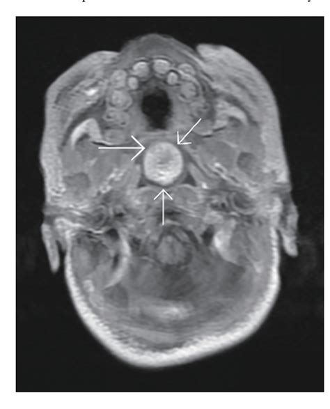 Figure 2 From Nasopharyngeal Teratoma In A Neonate Semantic Scholar