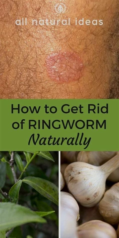 Natural Healing Get Rid Of Ringworm Natural Healing Remedies Natural Remedies