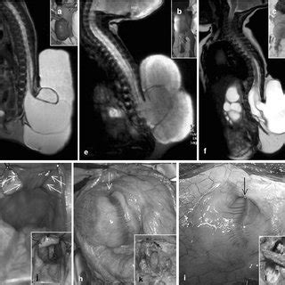 (PDF) Neurosurgical management of occult spinal dysraphism associated ...