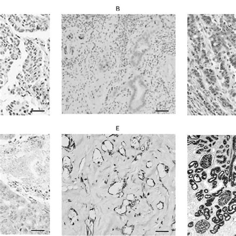 Immunohistochemical Analysis Of Cxcr2 And Cd133 Expression In Different