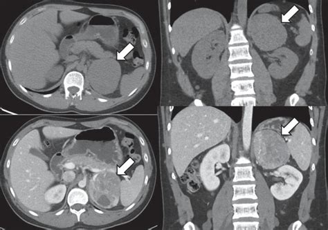 Pheochromocytoma In A Patient With Neurofibromatosis Type 1 Oncohema Key