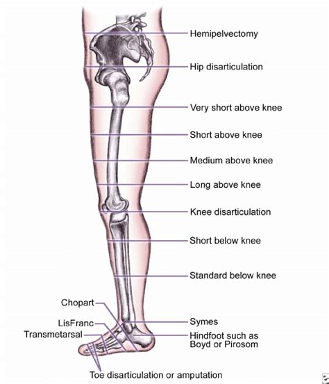 Levels Of Amputation Of The Lower Extremity Download Scientific Diagram